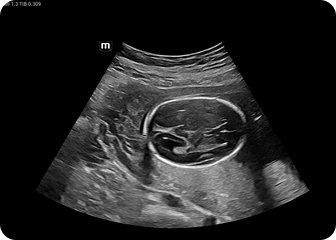 NuewaI8 Ultrazvucni aparati klinicke slike