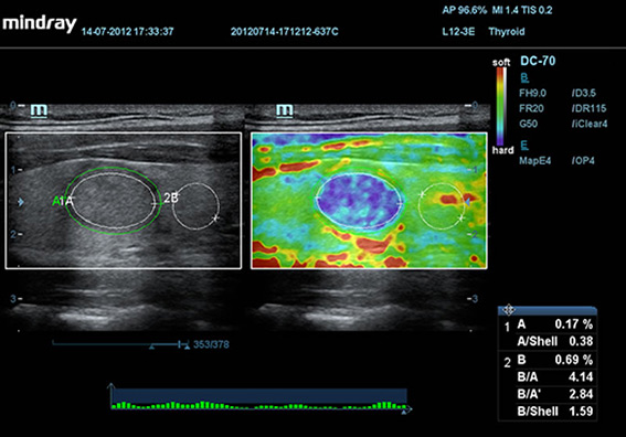 Thyroid Nodule Elastography with Unique Shell Analysis