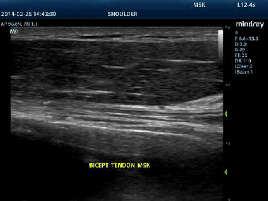 L12-4s_Bicep tendon